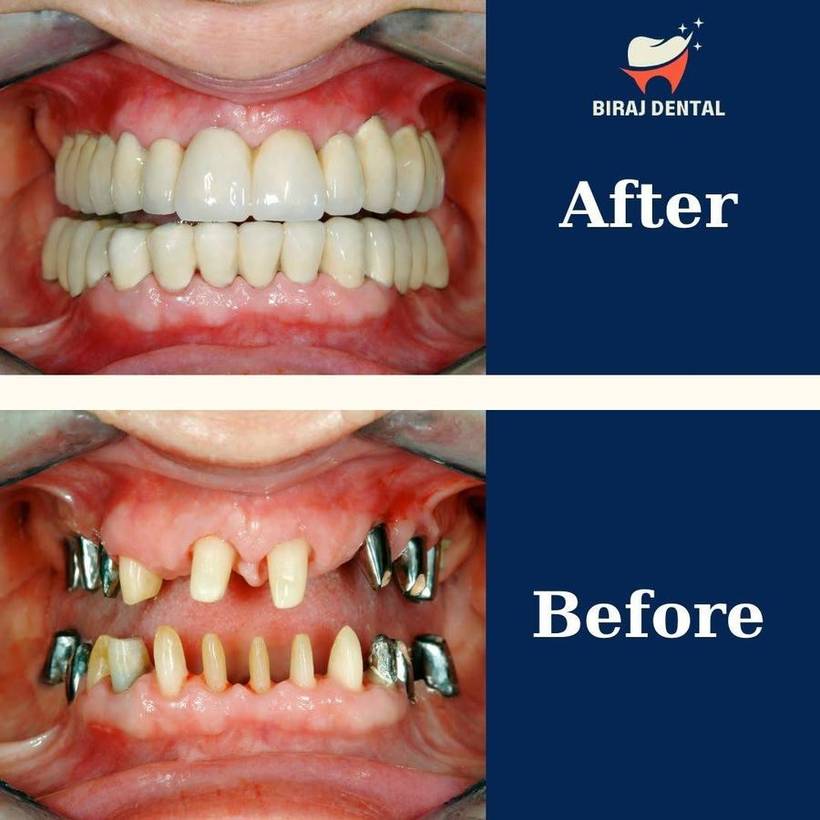 Full Arch Implant Restoration