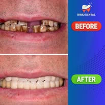 Smile Rehabilitation