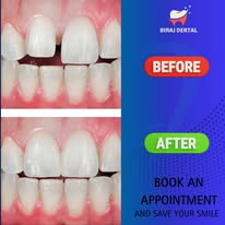 Teeth Whitening Result